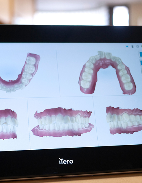 3D光学スキャナーiTero（アイテロ）